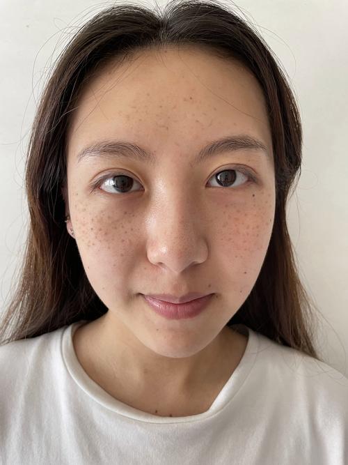 面部点斑后多久可以恢复图标