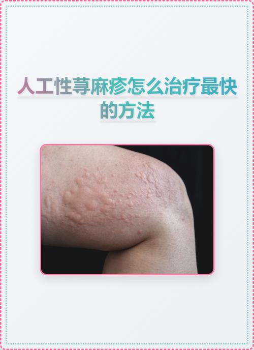 人工荨麻疹最快治疗方法