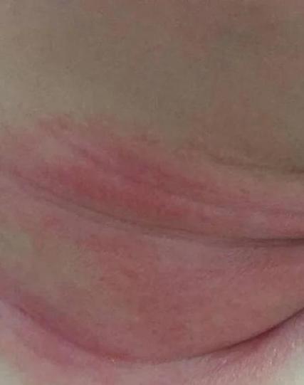 婴儿淹脖子可以用保湿霜吗