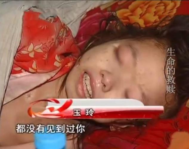 活人照片被烧多久病