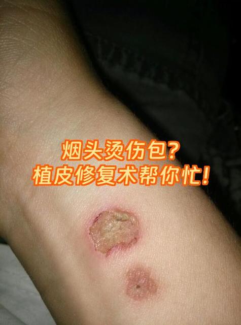 脸上溅油烫伤了留印怎么办